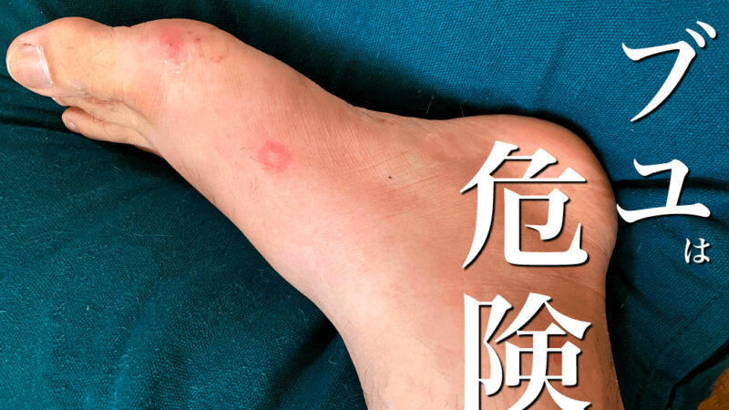 ブユ(ブヨ・ブト)は危険！痒みだけじゃなく痛くて歩けない？症状・対処法など